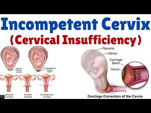 Incompetent Cervix (Cervical Insufficiency) – Causes, Symptoms, Diagnosis, Treatment - Gynecology