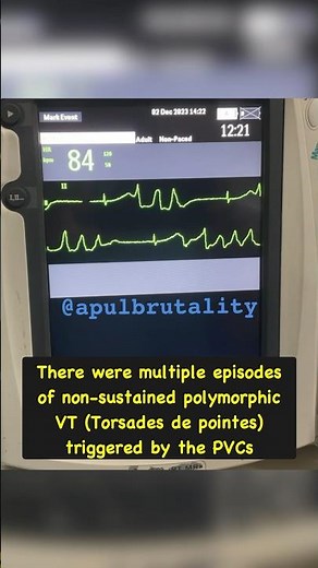 Prolonged QT interval - polymorphic ventricular tachycardia (VT) - Torsades de pointes