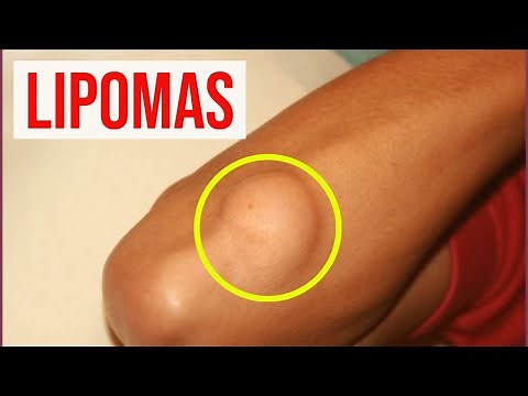 LIPOMA: symptoms, diagnosis, treatment and prognosis (fat balls, lumps or tumors)