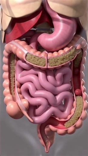 3D Animation of Constipation Explained | Gut Health