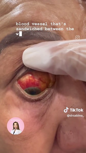 Subconjunctival hemorrhage due to elevated blood pressure. A blood vessel, ruptures, causing leakage of blood into the surrounding tissue. This is usually painless, and will resolve on its own in two weeks. However, if this reoccurs bloodwork is warranted to rule out disease. ##eyedoc##bloodyeye##eyehealth