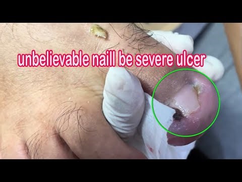 Severely Infected Ingrown Toenail Removal