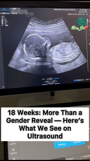 ✨Usapang ultrasound: 18 Weeks: More Than a Gender Reveal — Here’s What We See on Ultrasound.✨ At 18 weeks… we see more of your little love 🥹🤍 Not just gender—baby’s full anatomy check 💓 Doc Joie ❤️ #DocJoie #18WeeksPregnant #PregnancyUltrasound #BabyDevelopment #PrenatalCare #OBGYN #UltrasoundScan #HealthyPregnancy #DocJoieMoments | Mosquera-Palma Ob-Gyne, Ultrasound and High Risk Pregnancy Clinic