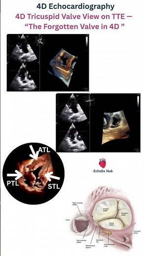 4D Tricuspid Valve – TTE (Surgeon’s View) #heartdisease #atrialseptaldefect