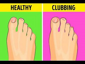 Clubbing of Fingers &Toes #Schamroth Window Test #Schamrothwindowtest #Clubbingcauses #Toes #fingers