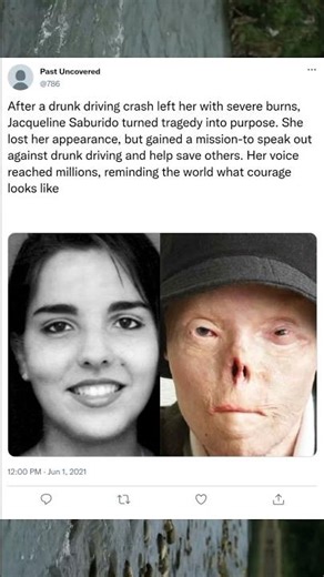 After a drunk driving crash left her with severe burns