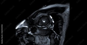 MRI heart or Cardiac MRI ( magnetic resonance imaging ) of heart showing heart beating for detecting heart disease.