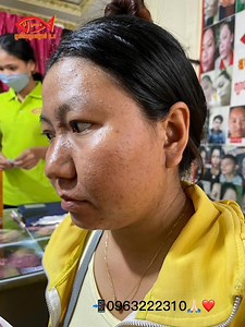 ❤️សួស្ដីបងប្អូនទាំងអស់គ្នា❤️ជាស្អាតម្នាក់ទៀតហេីយបងប្អូន ពីតំណាង ក្រុមហ៊ុនត្រីក្រហម ផ្សារដីថ្មី ជិតនិងស្តុបលូប្រាំ បងប្អូនទទួលសេវាកម្មតែមួយកញ្ចប់ ធានាជាអស់មុនស្នាម100%🥰របងប្អូនមើលតែមុខបងស្រីម្នាក់នេះទៅដឹងហើយពេលដែលគាត់មកទទួលសេវាកម្មព្យបាលដំបូងមុខមើលមិនយល់មុខមានមុនមានស្នាមហើយខ្មៅស្រអាប់ទៀតក្រោយពីគាត់ទទួលសេវាកម្មព្យាបាលអស់តែមួយកព្ចប់ឥឡូវនេះមុខរបស់គាត់ជាស្អាតហើយបងប្អូនស្អាតផ្លែក360°ហ្មងហាស់😘🤍បងប្អូនទាក់ទងតាមលេខ📲098288116//090288116សូមអគុណ🙏🏻🙏🏻 | ត្រីក្រហម សាខាបែកចាន