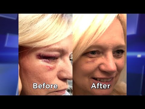 Can a Hard-Boiled Egg Help Your Bruise?