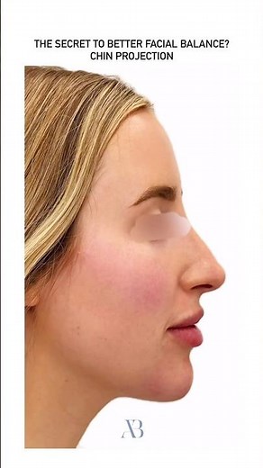 The Secret To Better Facial Balance? Chin Projection.