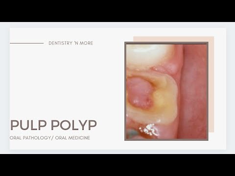 PULP POLYP || CHRONIC HYPERPLASTIC PULPITIS