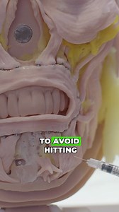 Depth of injection is everything when treating the depressor anguli oris. Go too deep or too low, and you risk hitting the depressor labii, leading to unwanted lip ptosis and asymmetry. Here’s the anatomical reason: The DLI dives underneath the DAO and attaches to bone beneath it. So if you inject too deep or too inferiorly, you’re right in its danger zone. Instead, stay superficial and more superior to precisely target the DAO and avoid complications. 📍This is just one of the clinical strategi