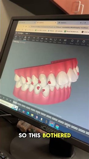 San Diego Invisalign: Fixing Overjet Without Braces