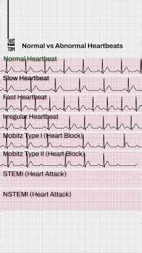 normal vs abnormal ECG #youtube #ecg #heratsound #shorts