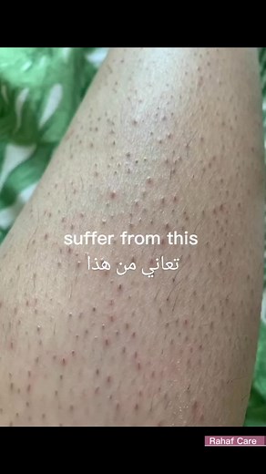 أسباب وطرق التعامل مع الشعر تحت الجلد