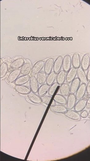 Enterobius vermicularis ova# Viral