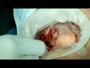 Part1 - Anatomically guided Pterygoid implant placement with Noris Pteryfit implant - DR.C.MURUGAVEL