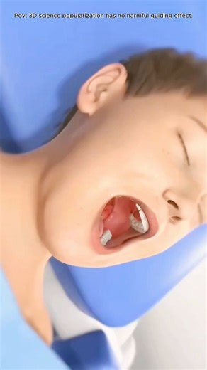 Tonsil and Adenoid Removal Surgery (Adenotonsillectomy)#3d #doctor #health