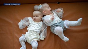 Conjoined twins successfully separated at the head in 24-hour operation