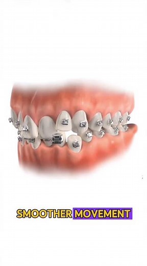 ✨ Self-Ligating vs Traditional Braces — What’s the Difference?