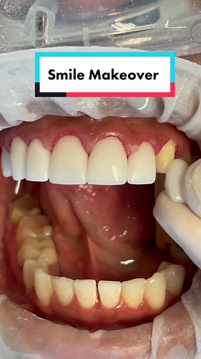 #new #smile #makeover #smilemakeover #preview #teeth #dental #dentist #tooth #try #on