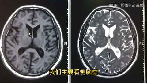 核磁T1WI和T2WI序列如何区分？
