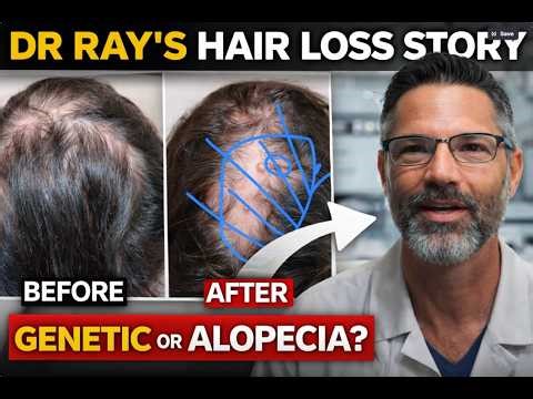 Dr Ray’s Own Hair Loss Story: Genetic Hair Loss + Alopecia Areata Explained