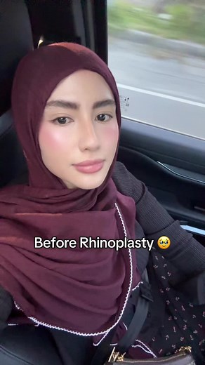 Rhinoplasty Journey: Before and After Transformation