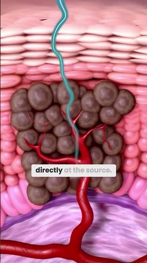 Watch a Cherry Angioma Disappear in 7-10 Days