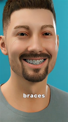 How Braces Actually Move Your Teeth (It's Not What You Think)