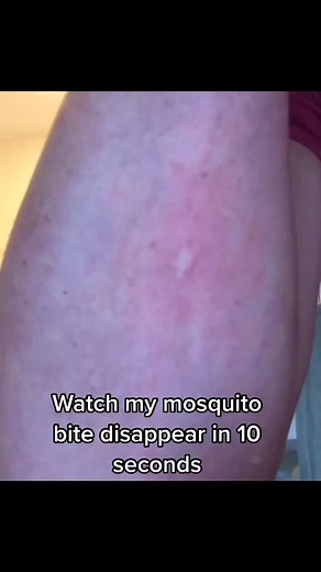 Instant Relief from Bug Bites and Stings!