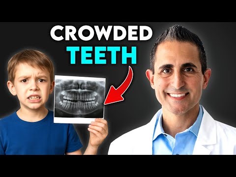 Do I Need a Palate Expander? Signs You Shouldn’t Ignore