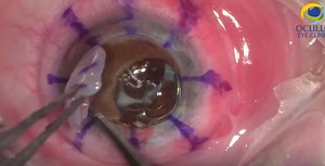 Penetrating Keratoplasty, IOL Exchange, Pupilloplasty, and Anterior Vitrectomy - Eyetube