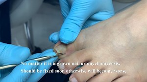 How to repair curled nail | Toenail 5