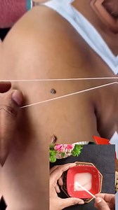 Remove warts permanently at home #wart #natural #healthtips #reels | Natural Beauty Tips