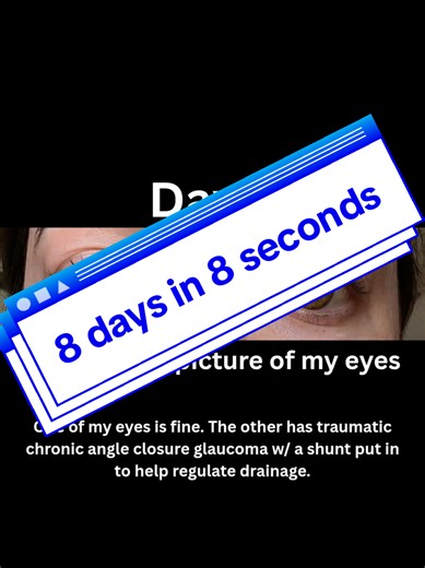 8 days of eyeballs! Help me stay motivated to post a photo of my eye every day! This project is to document my eye for at least 100 days (and hopefully a full year). A like or follow would really help keep me accountable. For context: 1) I see my ophthalmologist every 3 months (sometimes more). 2) It’s not uveitis — I have a glaucoma shunt and do 5 prescription eye drops every day. The redness you see is often from side effects of the drops, dryness, and eye fatigue. 3) I’m also partially blind 