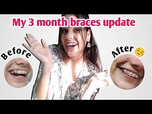 My Braces Journey 3 month update pain, struggles & changes ?🤔