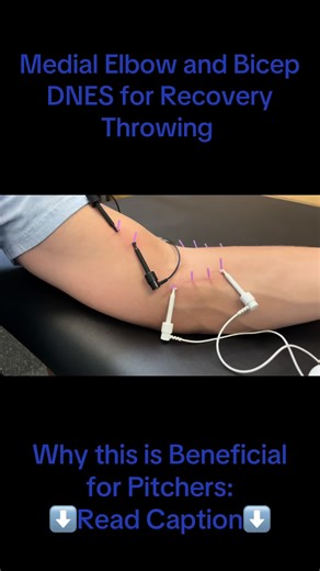 DNES = Dry Needling with Electrical Stimulation ⚡️🪡 In this video, we’re using DNES on the medial elbow and biceps—key tissues heavily stressed during throwing and pitching, especially through the late cocking and deceleration phases. How it works: Fine needles are placed into specific muscle trigger points and connected to a low-level electrical current. This creates controlled muscle contractions that help normalize neuromuscular signaling and reduce excessive tone in overworked throwing musc