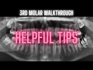 Third Molar Extraction Video | Helpful Tips • Video • MEDtube.net