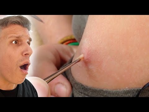 Dermatologist reacts to Botfly Maggot Removal video!