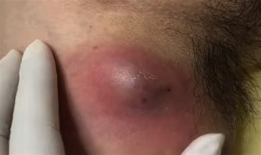 Severe Infected Underarm Cyst Drainage