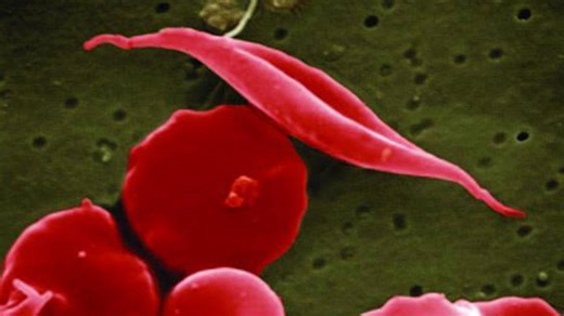 South Carolina promotes sickle cell programs during awareness month