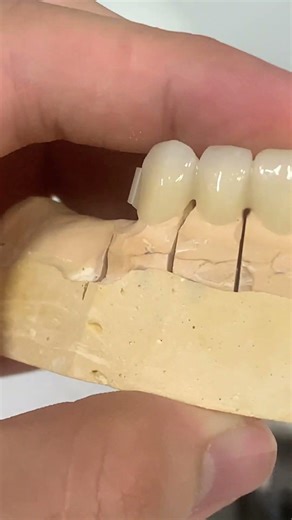 Zirconium bridge on attachment #music #technology #dentist #like #work