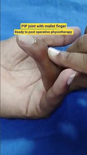 PIP joint stiffness & mallet finger #physiotherapist #splint#postoperative #stiffness #deformity