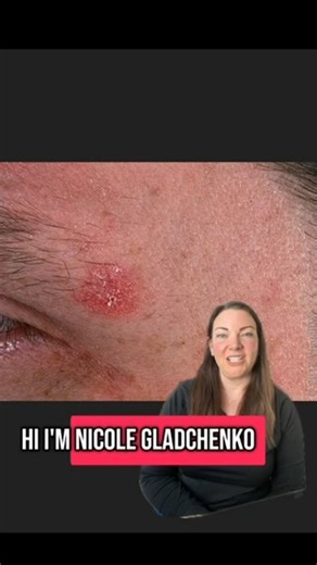 Dermatology PA Nicole Gladchenko walks through real examples of common skin conditions—including what signs of skin cancer can look like. 👀 Photos are for awareness only. If you notice anything new or unusual on your skin, always have it checked by a professional! Schedule an appointment with Nicole online today: https://bit.ly/3NlvD69 | Mercyhealth McHenry County