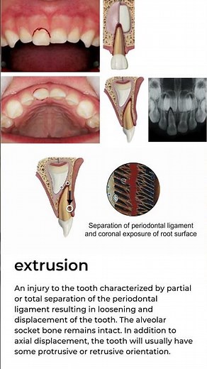 Extrusion Primary Teeth | Pesh Orthodontics
