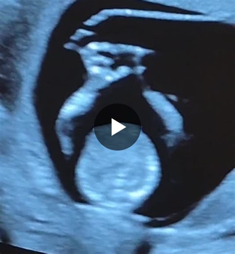 Early Fetal Hand Assessment in First Trimester Ultrasound | Coskun Umit posted on the topic | LinkedIn