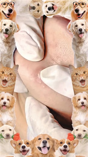 My god!!!😱💕#pimple #cyst #blackhead #USblackhead #cystpopping #fyp