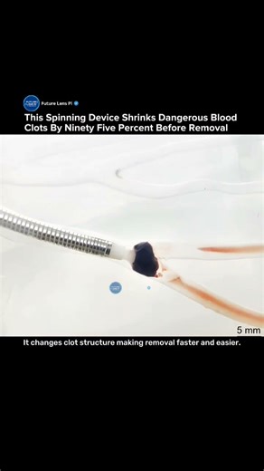 New Spinning Device Removes Deadly Blood Clots in Seconds Without Surgery #stroke #treatment #tech