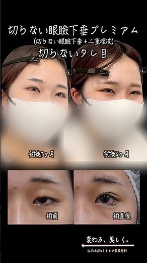 切開せずに整える目元治療｜切らない眼瞼下垂×タレ目形成の変化